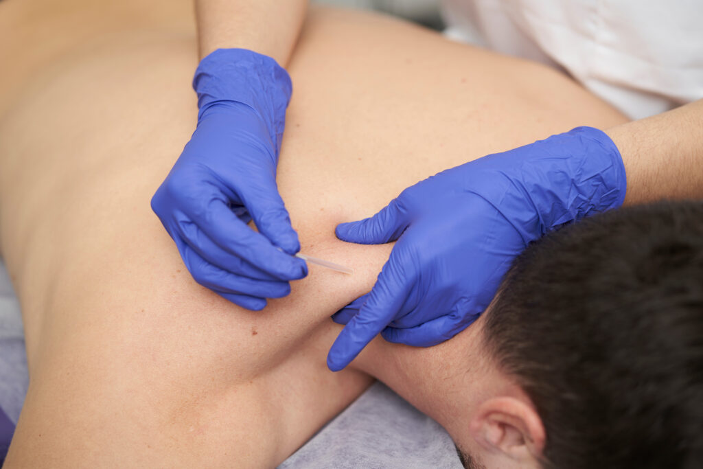 Image of physical therapist treating a patient with dry needling